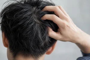 フケ・かゆみが気になる。頭皮ケアの基本と、洗い方の見直し方